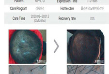 30대 남성 정수리 탈모 리커버리
