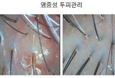 여성두피 염증성두피 3개월관리후기
